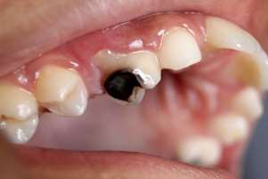  آیا می‌دانستید؟ پوسیدگی دندان (Dental caries) شایع‌ترین بیماری غیرواگیر در جهان است که بیش از ۲.۵ میلیارد نفر را درگیر کرده است.