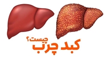 دانستنی‌های مهم در خصوص کبد چرب (Fatty Liver Disease)